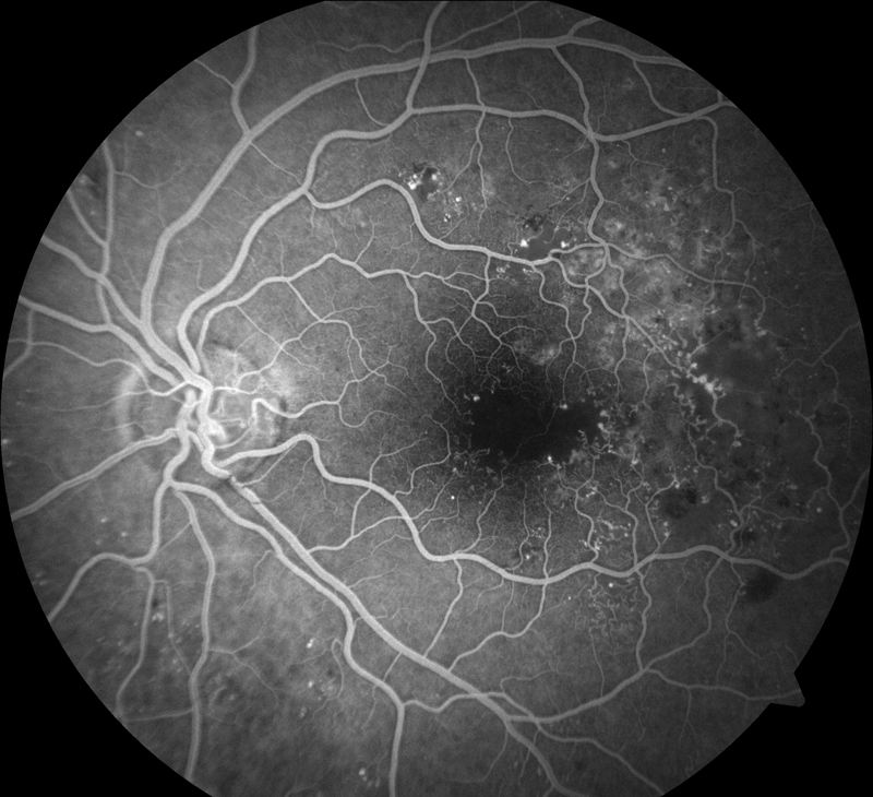 Diabetic-maculopathy-with-compromised-blood-supply